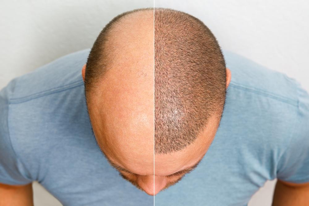 زراعة الشعر في الرياض