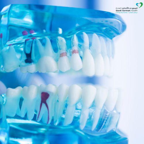 أخطر أنواع تسوس الأسنان